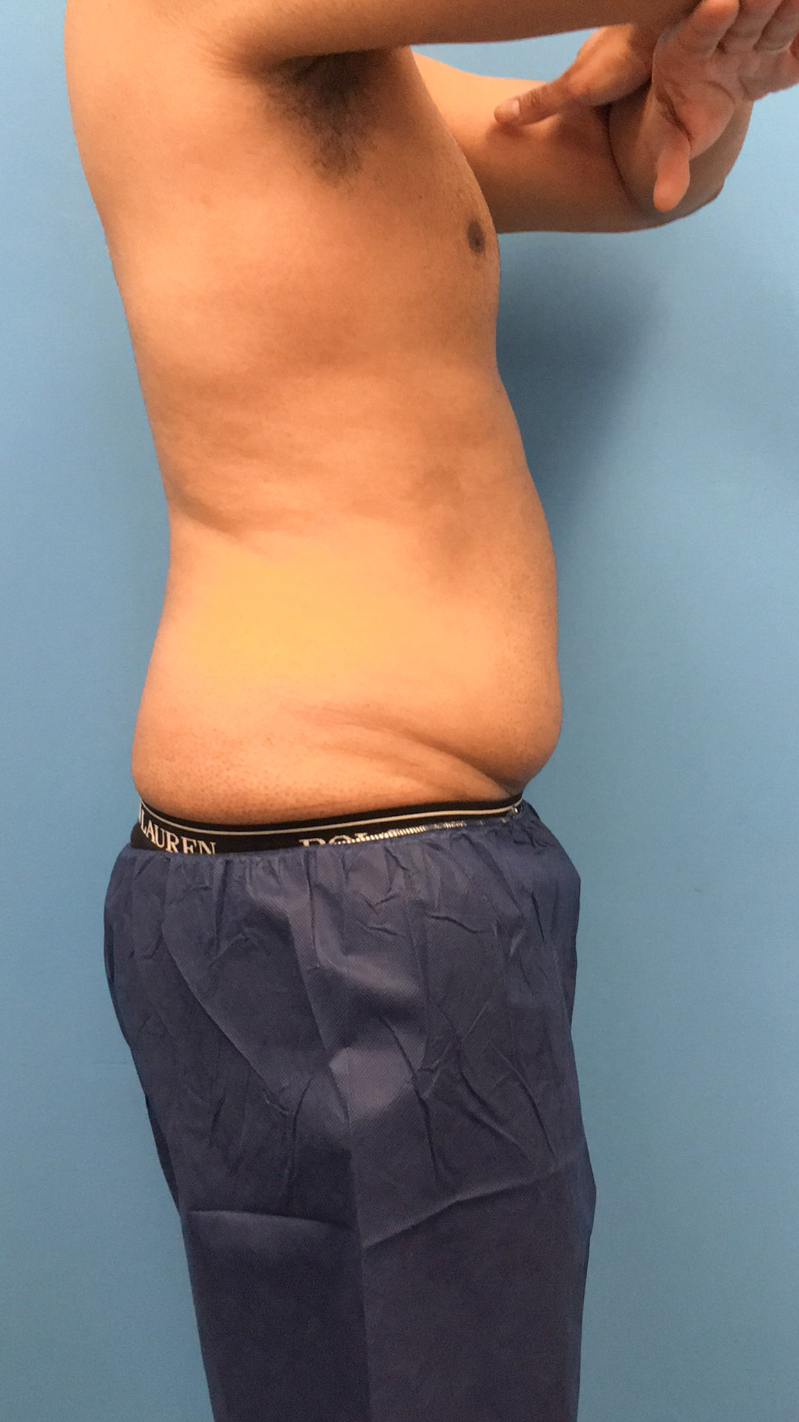 Lipo-360-Case--4979 | Before Liposuction 2