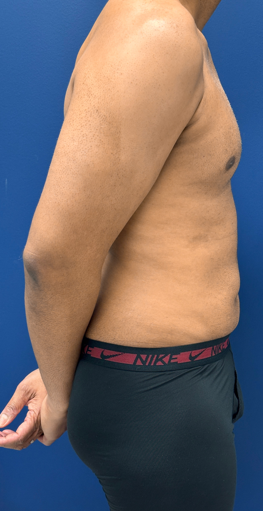 Lipo-360-Case--4979 | After Liposuction 2