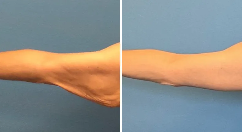 Before and after arm lift: man's arms from the left side