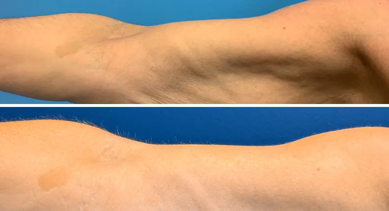 Before and after arm lift: patient's arms from the right side