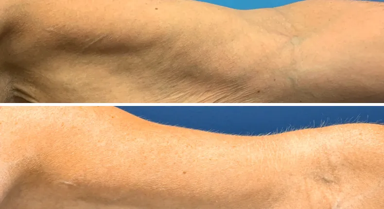 Before and after arm lift: patient's arms from the left side