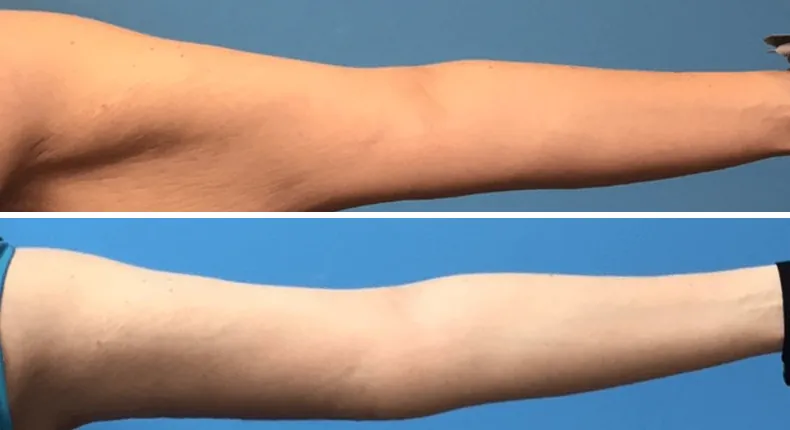 Before and after arm lift: woman's arms from the front
