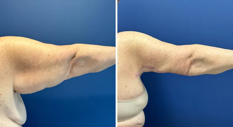 Before and after arm lift: patient's arms from the right side