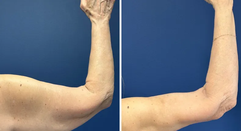Before and after arm lift: patient's arms from the right side