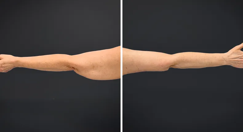 Before and after arm lift: woman's arms from the back