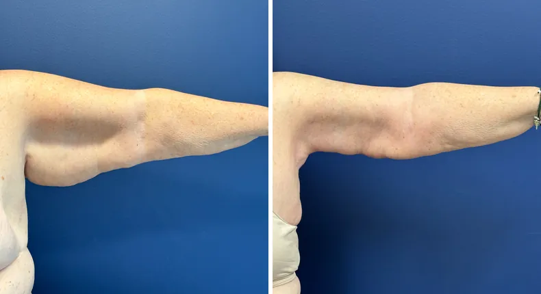 Before and after arm lift: patient's arms from the left side