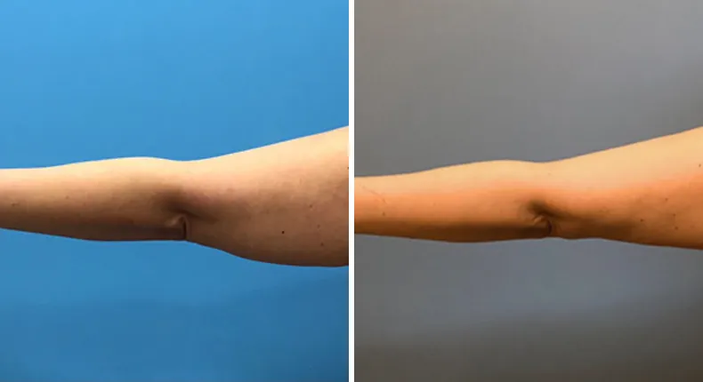 Before and after arm lift: woman's arms from the back