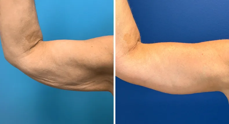 Before and after arm lift: patient's arms from the right side