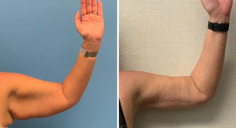 Before and after arm lift: patient's arms from the left side