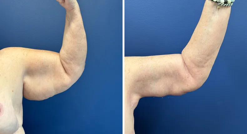 Before and after arm lift: patient's arms from the left side