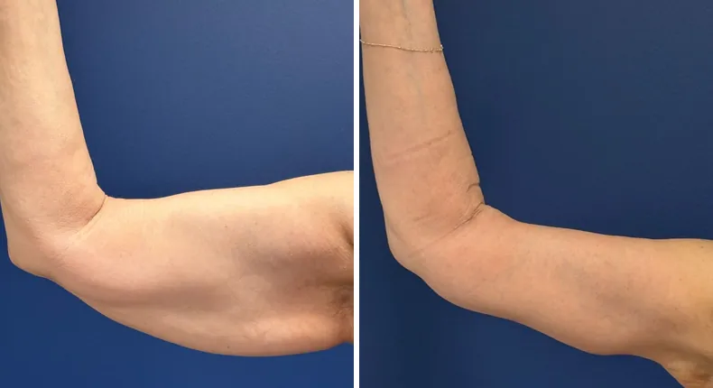 Before and after arm lift: patient's arms from the left side