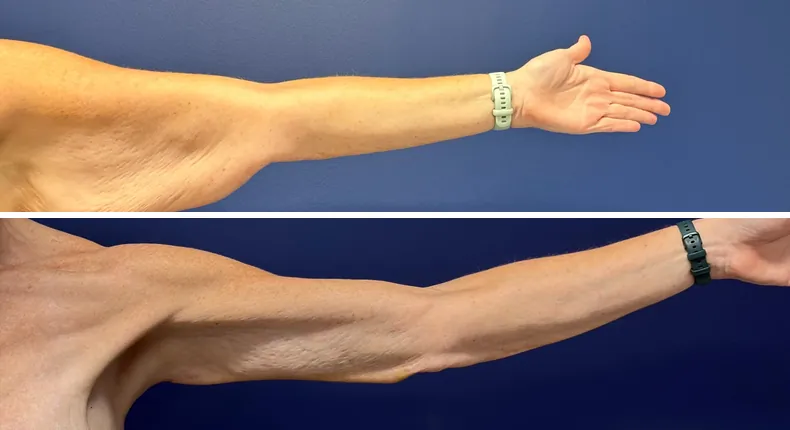 Before and after arm lift: patient's arms