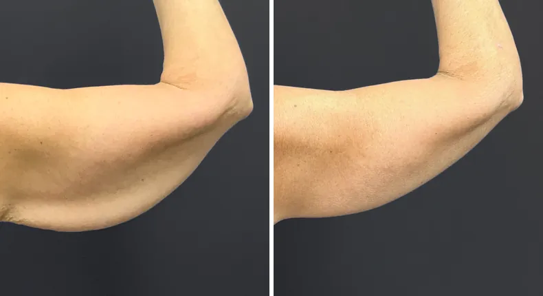 Before and after arm lift: patient's arms from the back