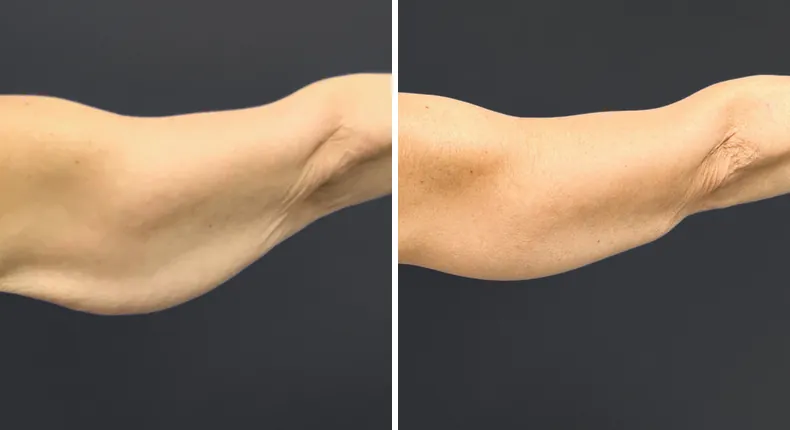 Before and after arm lift: patient's arms from the back