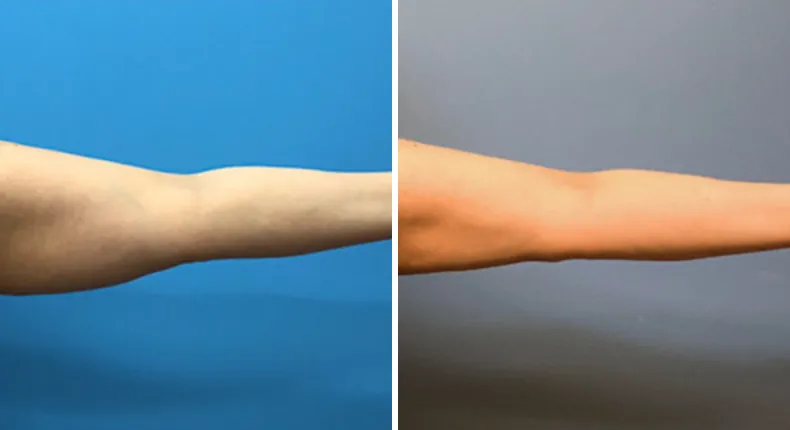Before and after arm lift: woman's arms from the front