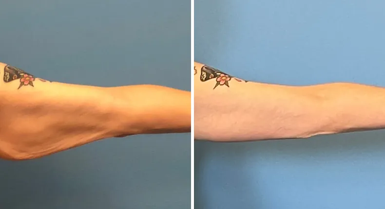 Before and after arm lift: man's arms from the right side