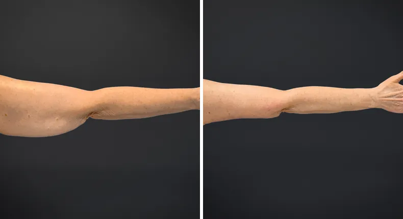 Before and after arm lift: woman's arms from the back