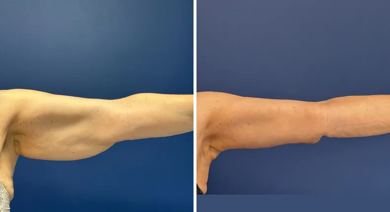 Before and after arm lift: patient's arms from the right side
