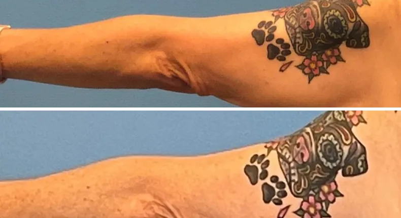 Before and after arm lift: woman's arms