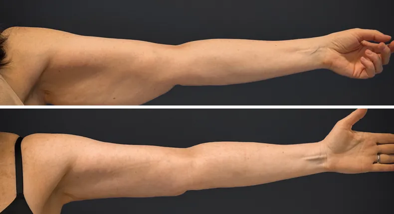Before and after arm lift: woman's arms from the front