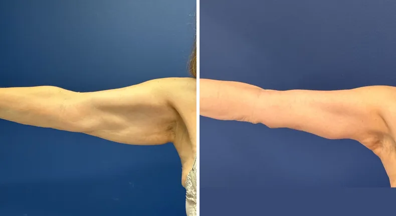 Before and after arm lift: patient's arms from the left side
