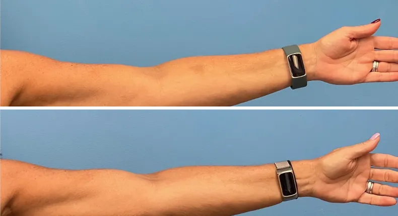 Before and after arm lift: patient's arms from the right side