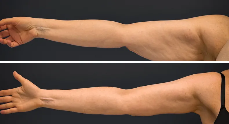 Before and after arm lift: woman's arms from the front
