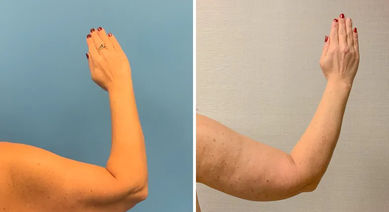 Before and after arm lift: patient's arms from the right side