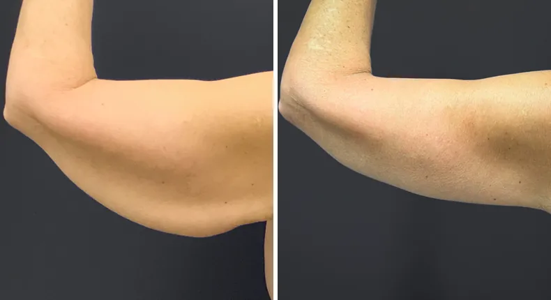 Before and after arm lift: patient's arms from the back