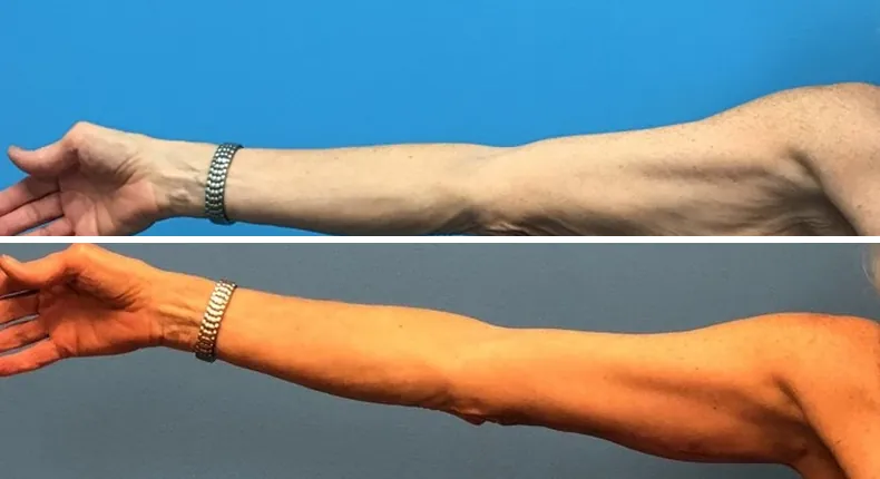 Before and after arm lift: woman's arms
