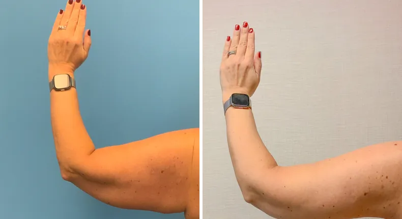 Before and after arm lift: patient's arms from the left side