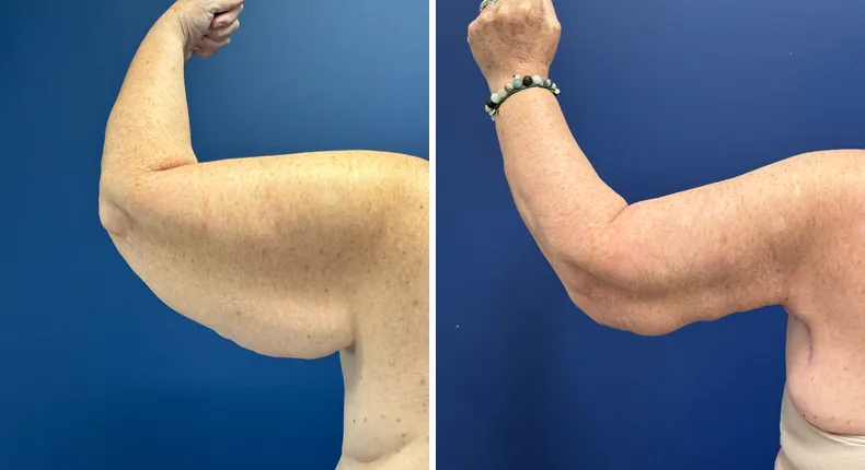 Before and after arm lift: patient's arms from the left side