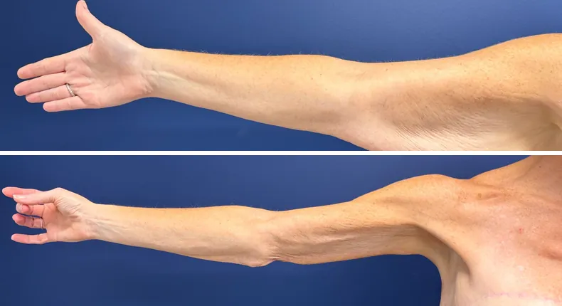Before and after arm lift: patient's arms
