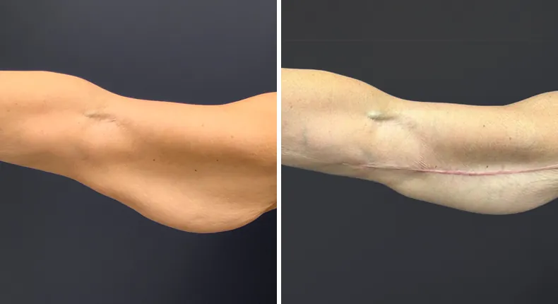Before and after arm lift: patient's arms from the front