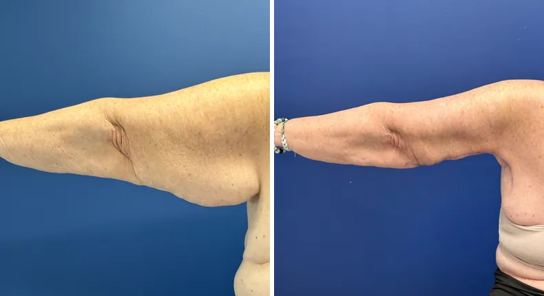 Before and after arm lift: patient's arms from the left side