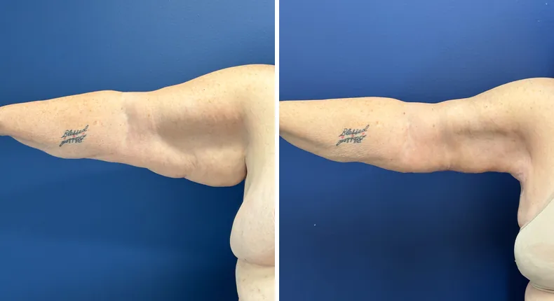 Before and after arm lift: patient's arms from the right side