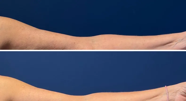Before and after arm lift: patient's arms