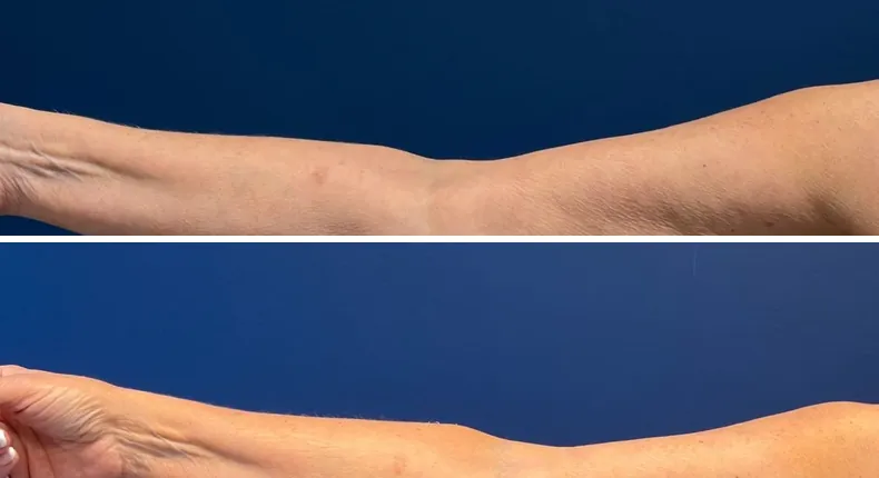Before and after arm lift: patient's arms