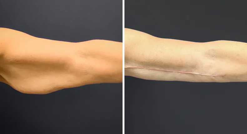 Before and after arm lift: patient's arms from the front
