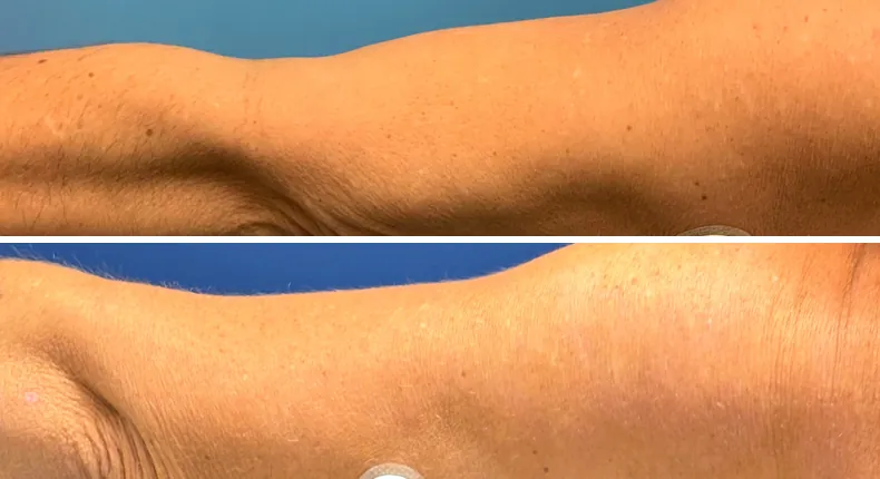 Before and after arm lift: patient's arms from the left side