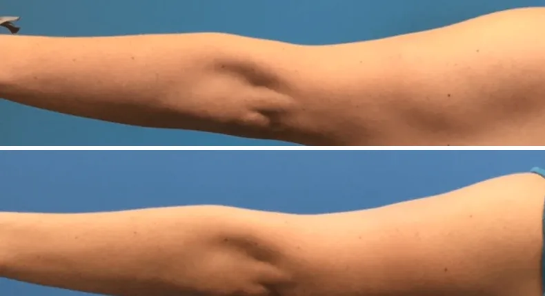 Before and after arm lift: woman's arms from the back