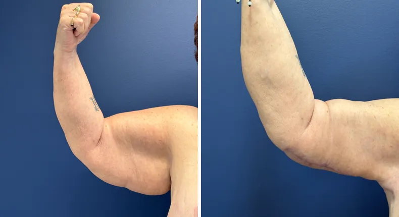 Before and after arm lift: patient's arms from the right side