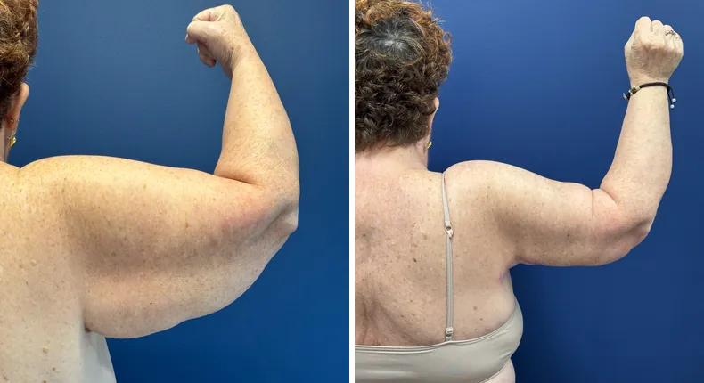 Before and after arm lift: patient's arms from the right side