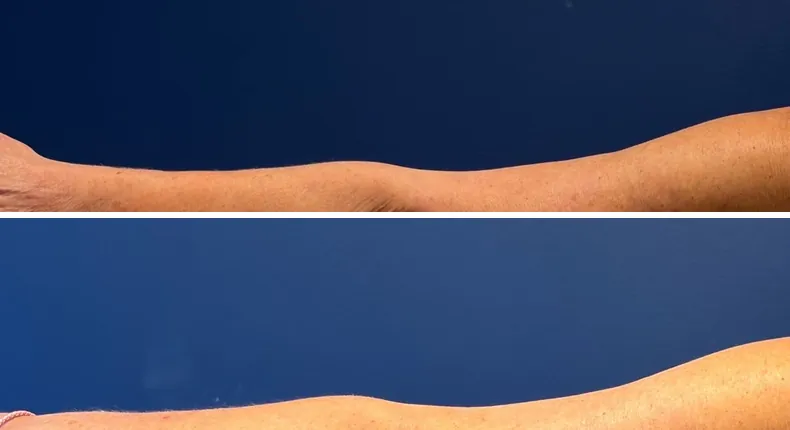 Before and after arm lift: patient's arms