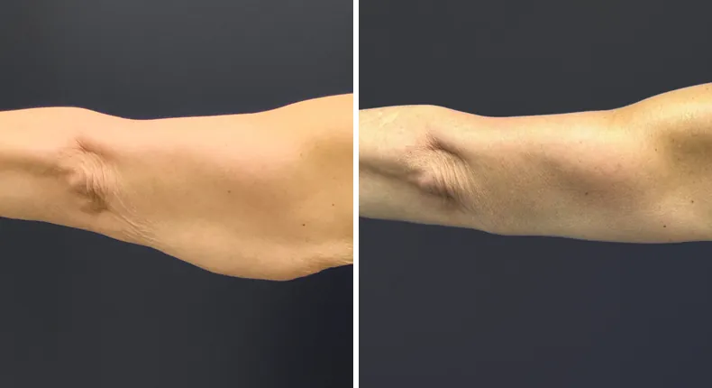 Before and after arm lift: patient's arms from the back