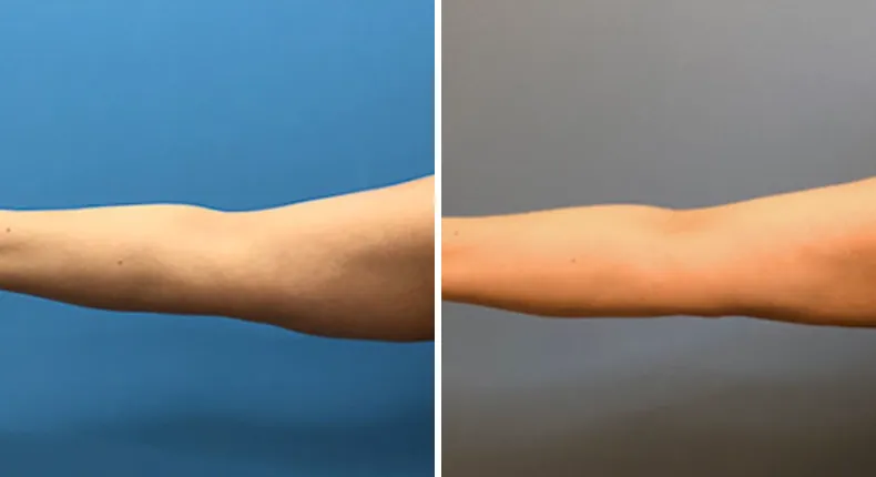 Before and after arm lift: woman's arms from the front