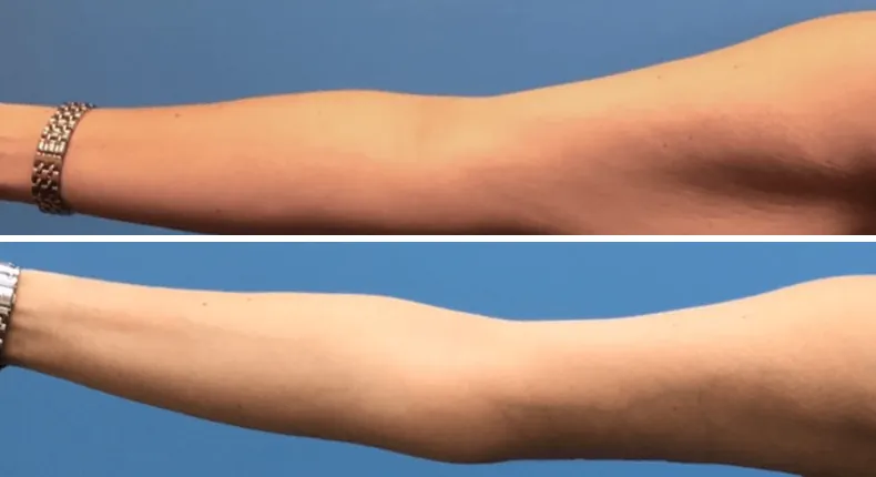 Before and after arm lift: woman's arms from the front