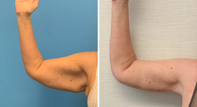 Before and after arm lift: patient's arms from the right side
