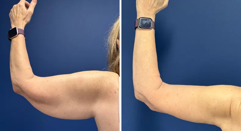 Before and after arm lift: patient's arms from the left side