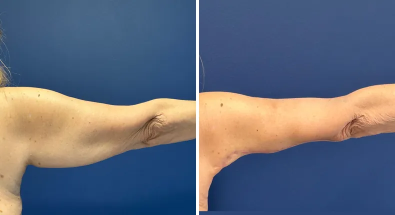 Before and after arm lift: patient's arms from the right side
